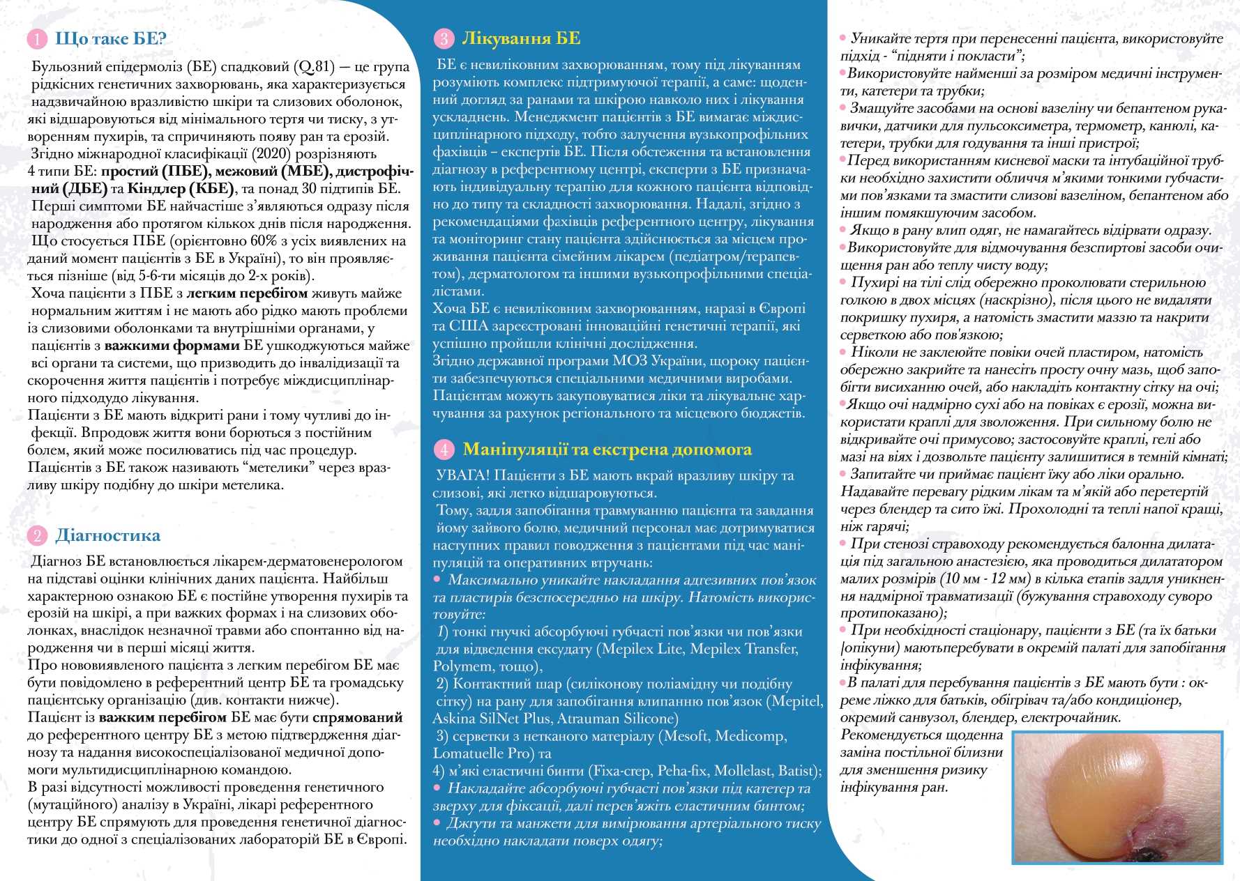 Бульозний епідермоліз